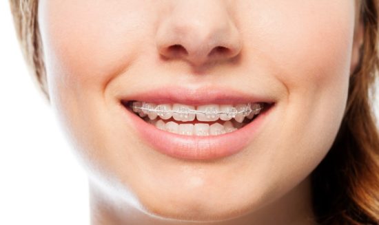 Ceramic Braces