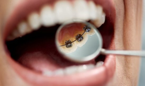 Lingual Braces