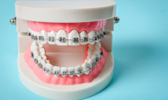 Metal Braces