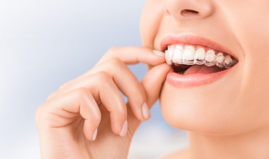 What Are Dental Braces?