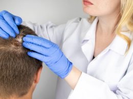 SCALP MICROPIGMENTATION FOR SCARRING ALOPECIA