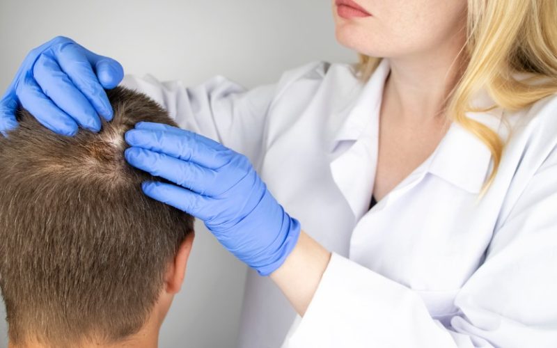 SCALP MICROPIGMENTATION FOR SCARRING ALOPECIA